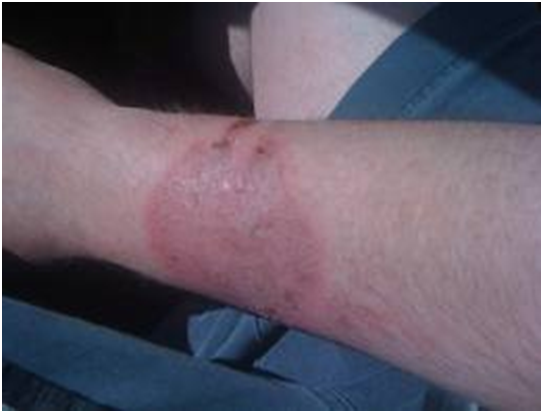 Burns on forearms from heated airbag deployment gases